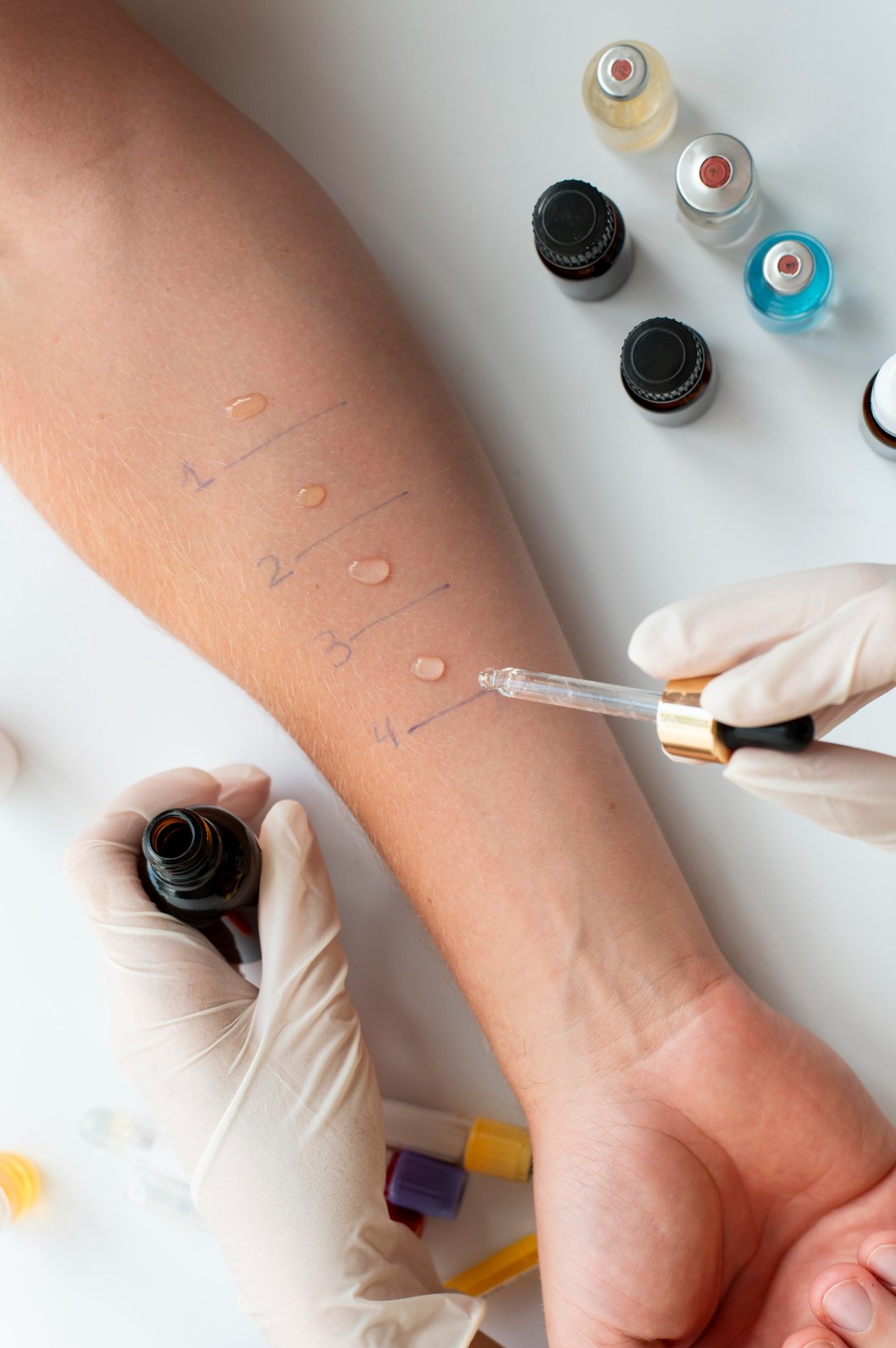 Antebraço durante a realização do Prick Test